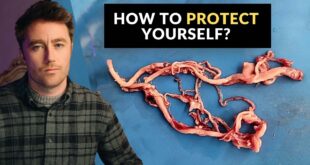 Amyloid Clots Found in EVERY SINGLE PERSON: Brand New Study