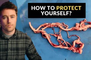 Amyloid Clots Found in EVERY SINGLE PERSON: Brand New Study